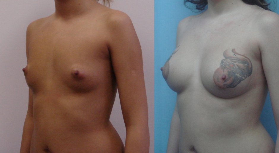 Тубулярная молочная железа