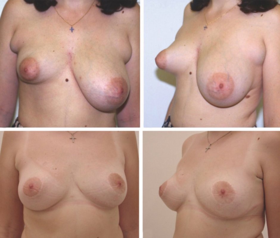 Тубулярная форма молочных желез у женщин