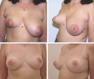 Тубулярная форма молочных желез у женщин