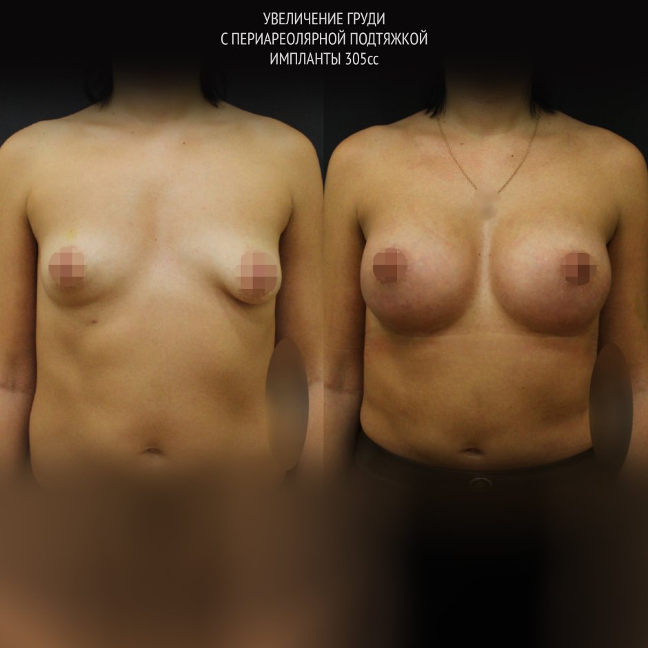 Увеличила сиськи до и после