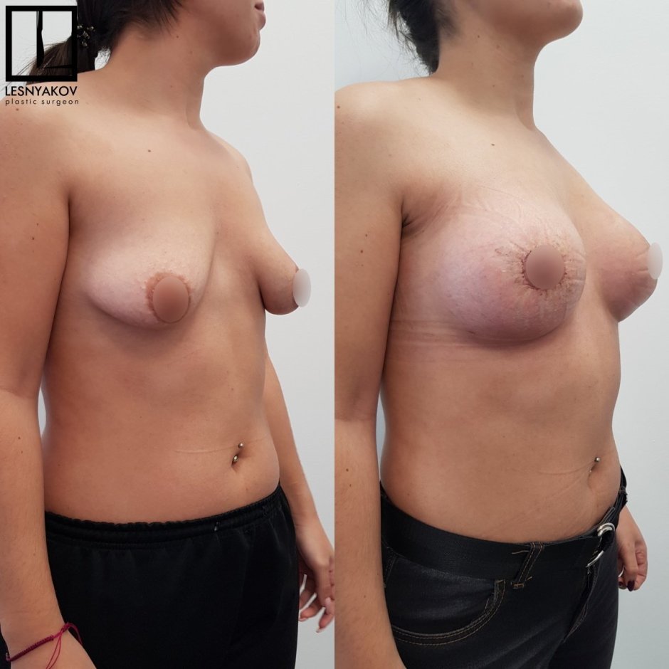 Сиськи анатомический имплант