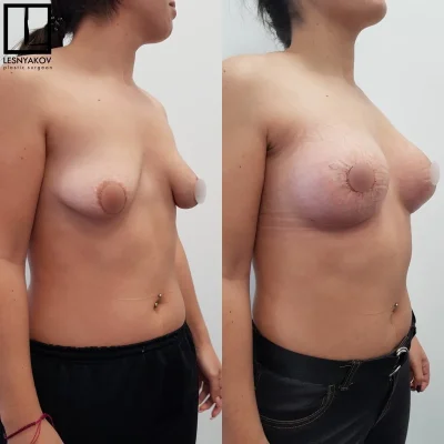 Сиськи анатомический имплант