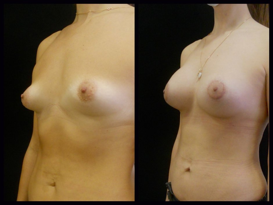 Тубулярность молочных желез фото