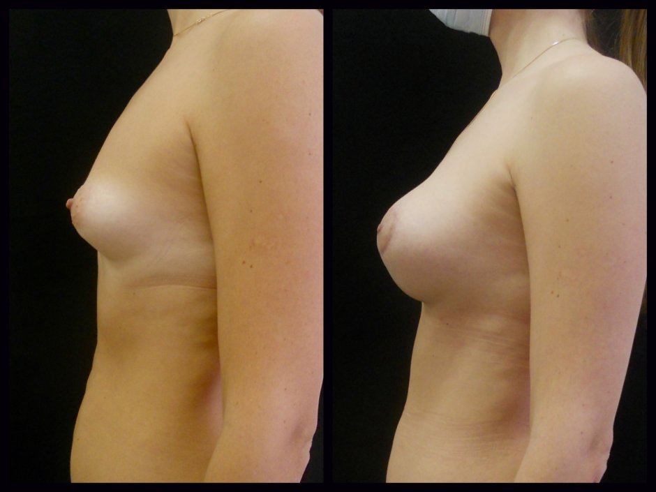 Тубулярность молочных желез