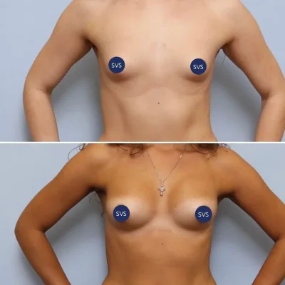 Голые сиськи после операции