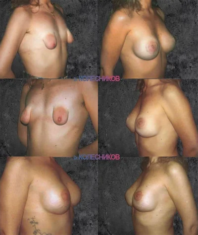 Тубулярная деформация молочных желез