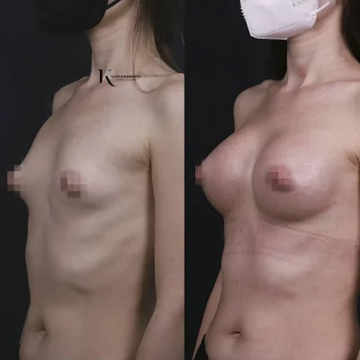 Пластика груди