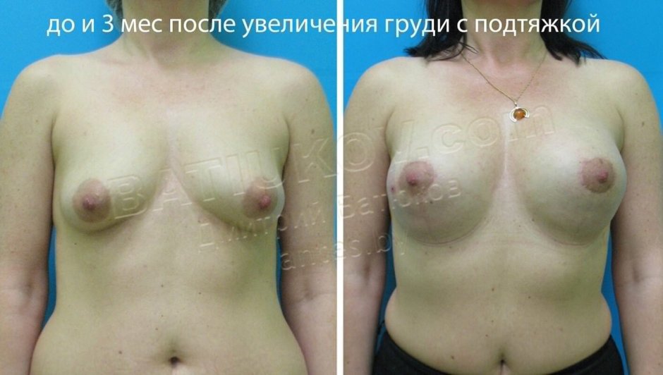 Тубулярная деформация груди