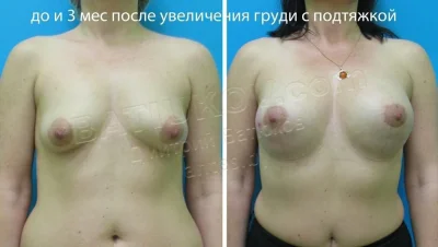 Тубулярная деформация груди