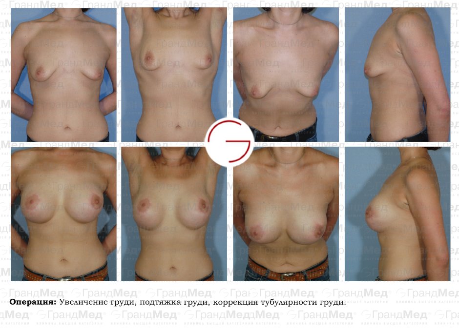 Ареолярная мастопексия