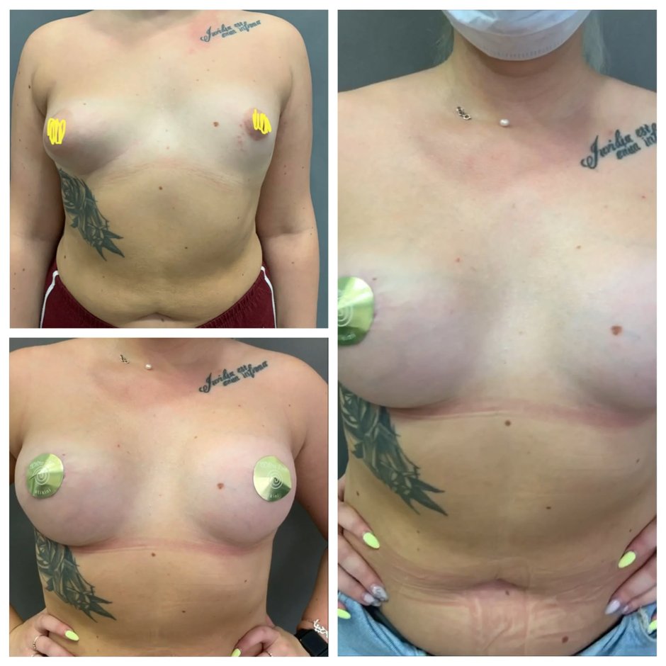 Увеличение груди