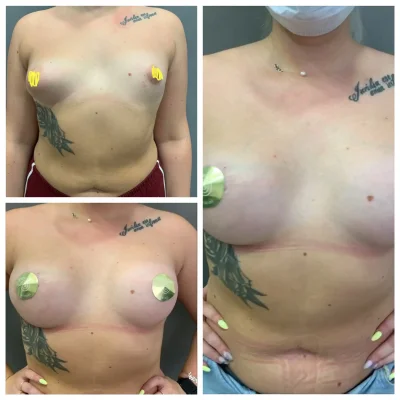 Увеличение груди