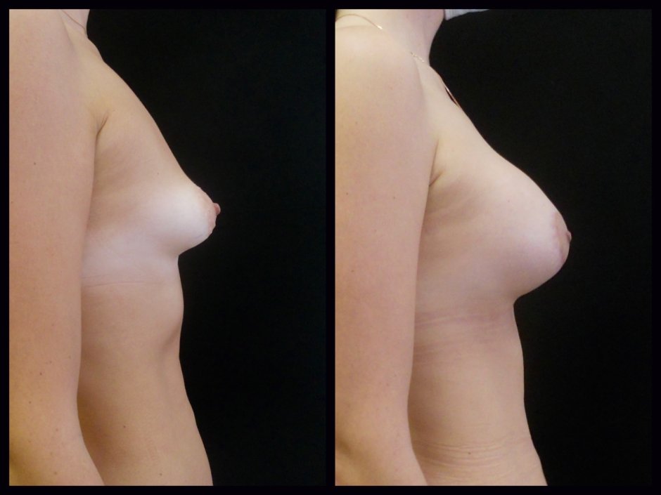 Сжимает соски