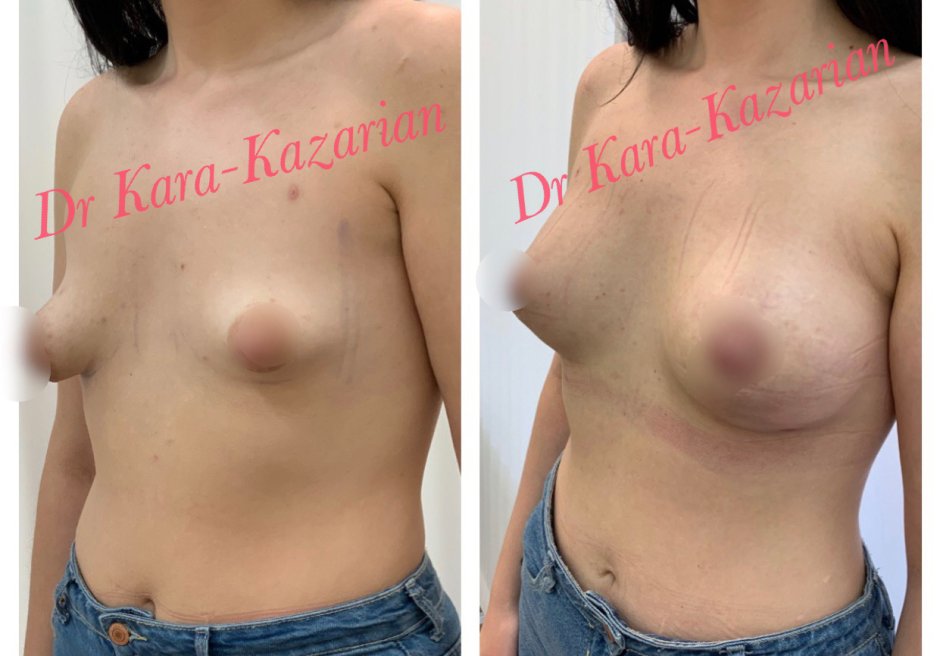 Коррекция грудных желез