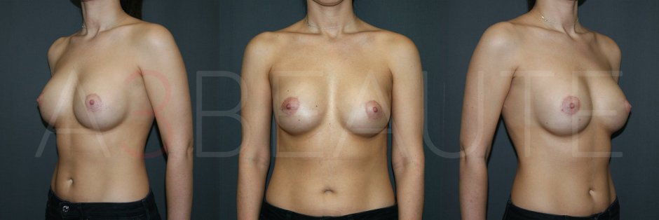 Грудь женщины после родов