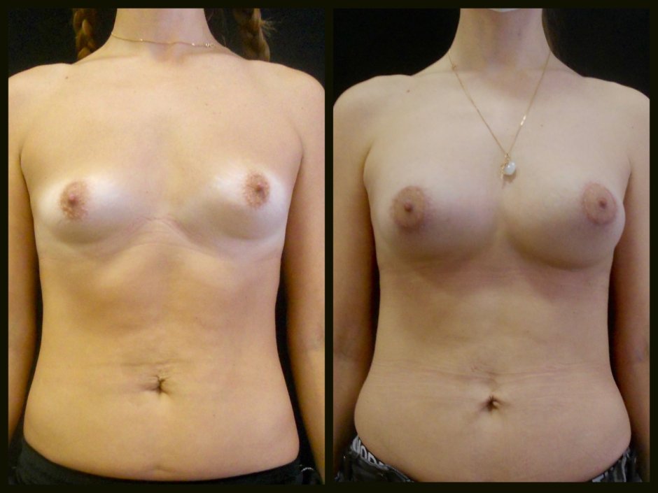 Эндопротезирование молочных желез