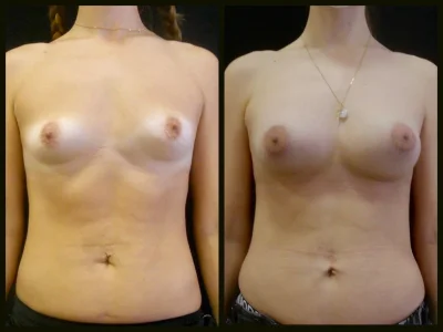 Эндопротезирование молочных желез