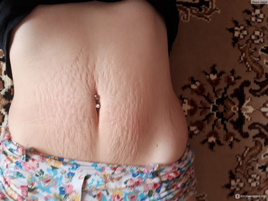 Растяжки на животе после родов