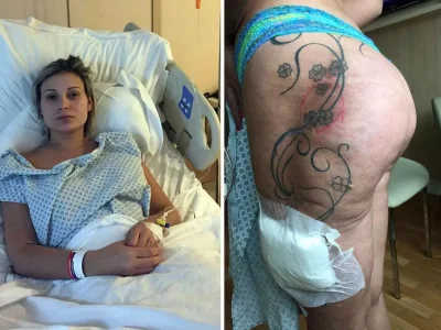 Операция по увеличению ягодиц