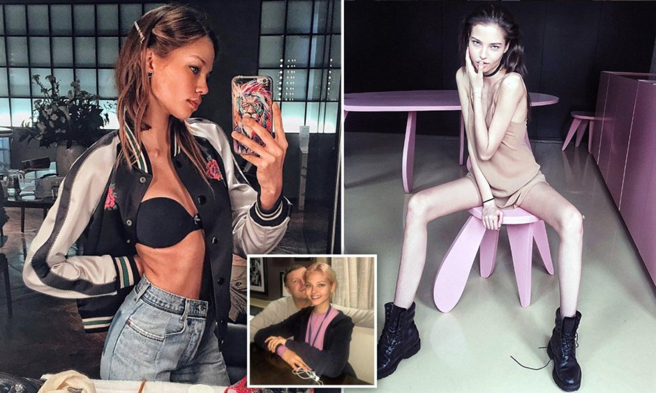 Алеся кафельникова анорексия