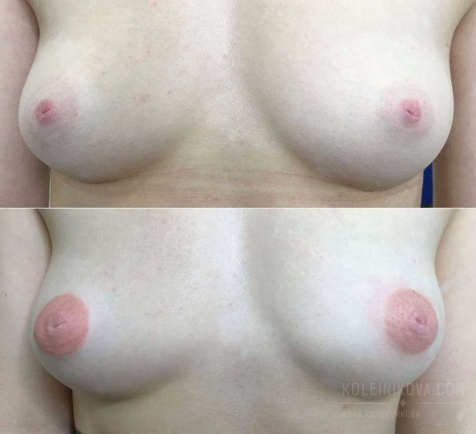 Увеличение груди