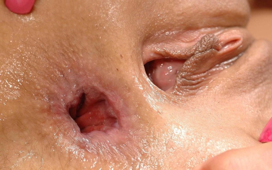 Геморроидальные узлы