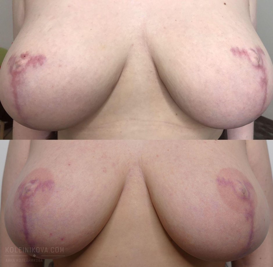 Ареола груди