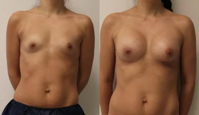 Увеличение груди