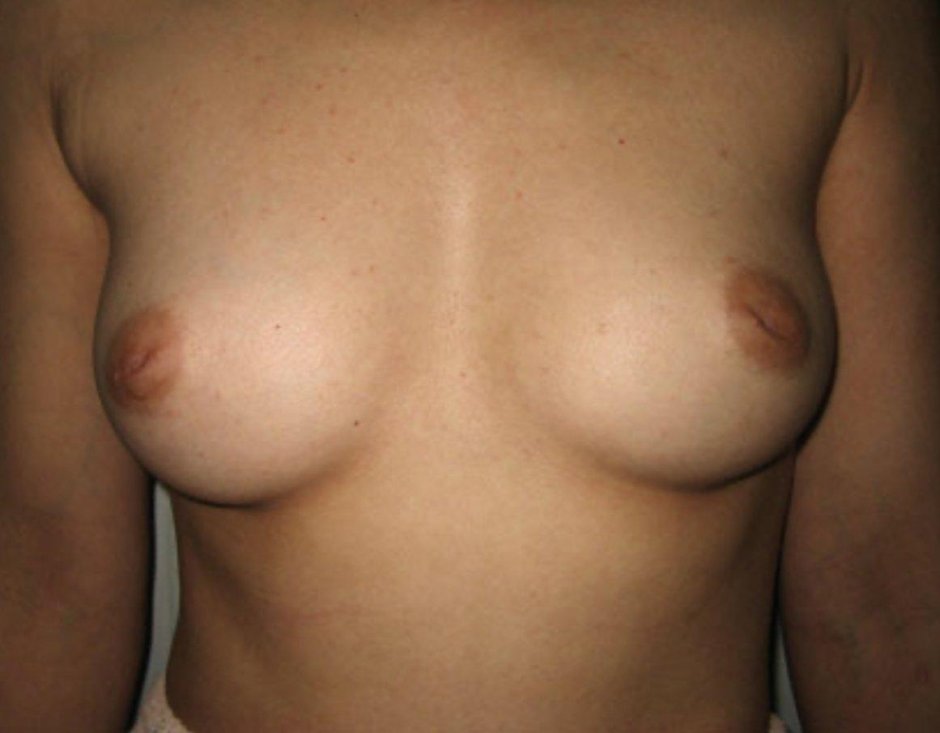 Увеличение груди