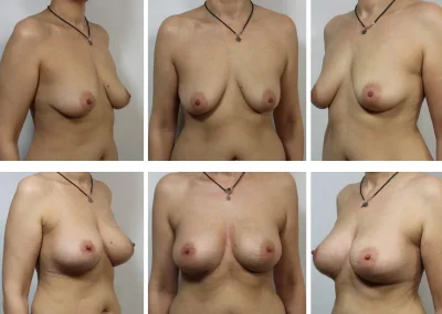 Грудь с круглыми имплантами