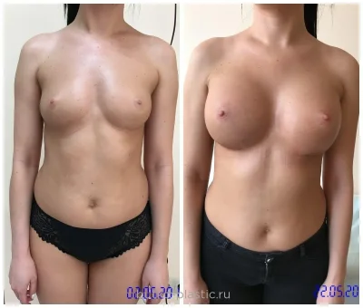 До и после увеличения груди