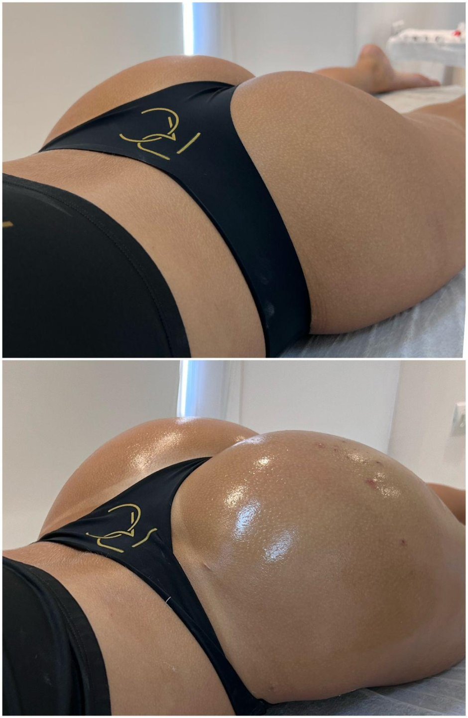 Увеличение ягодиц