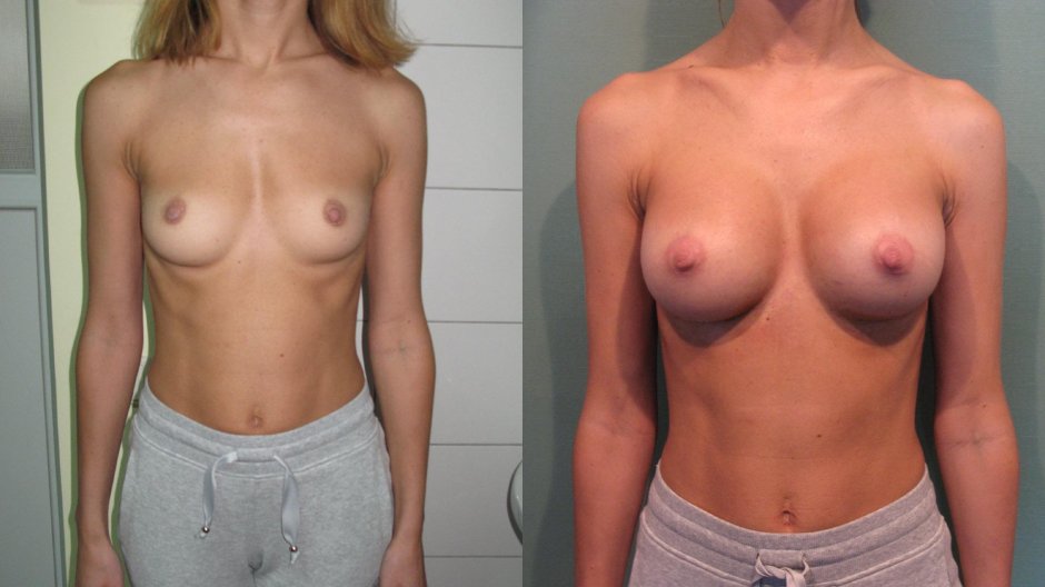 Грудь пластика