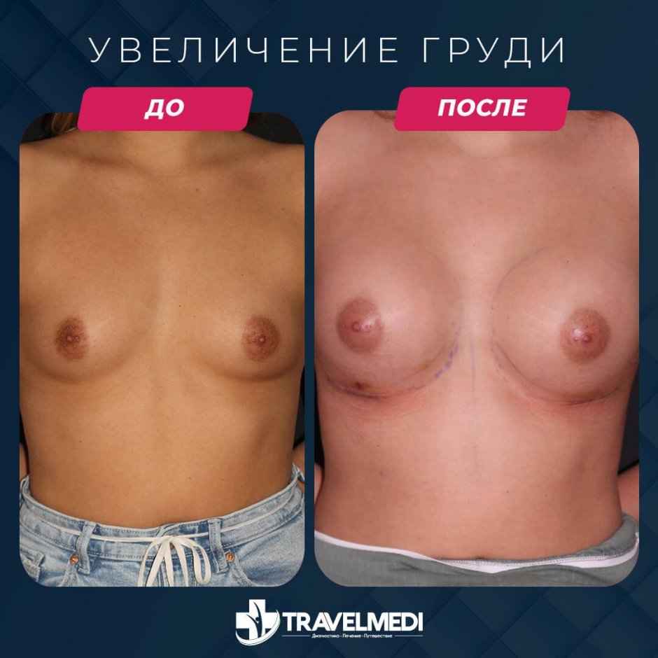 Для увеличения груди