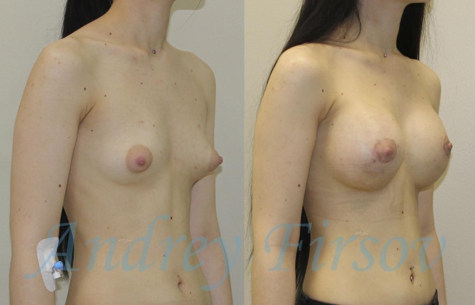 Эстрадиоловая гинекомастия