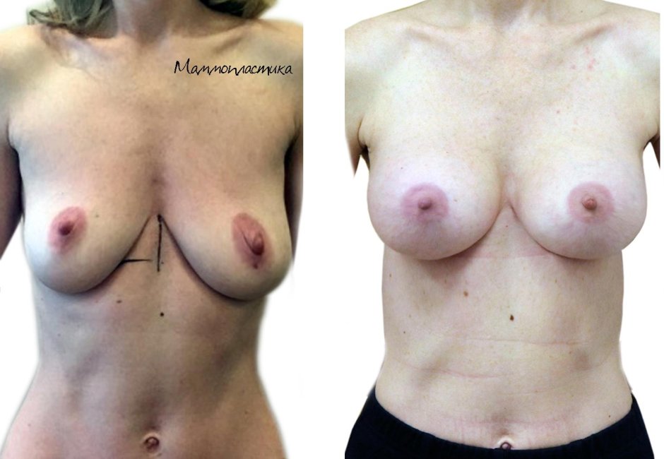 Грудь после беременности