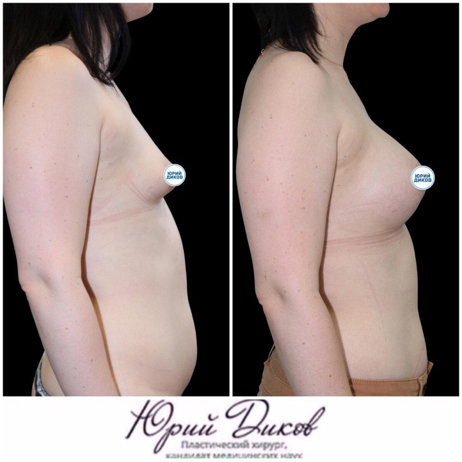 Тубулярная форма груди