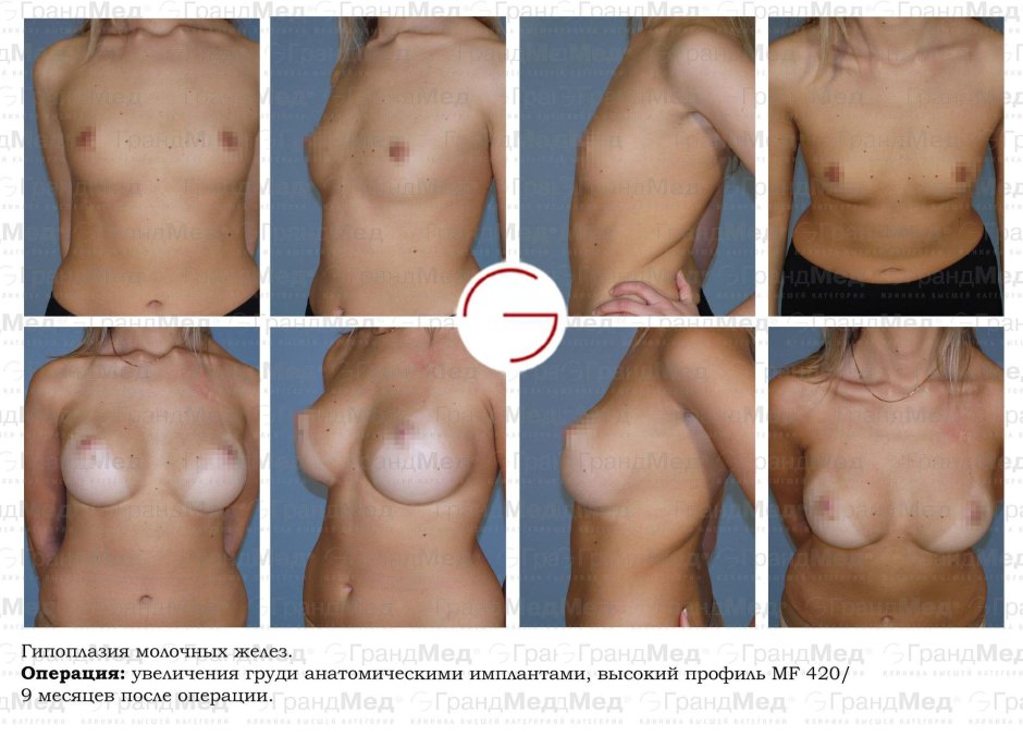 Гипоплазия молочных желез у женщин