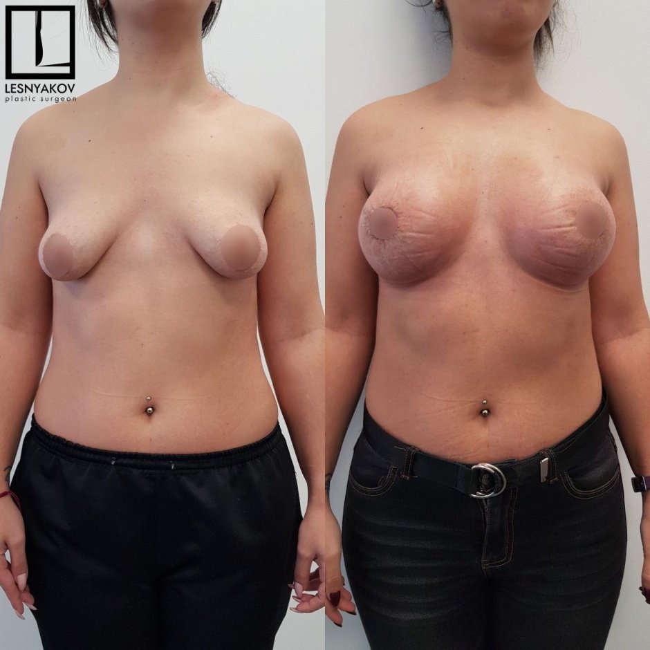 До и после подтяжки груди