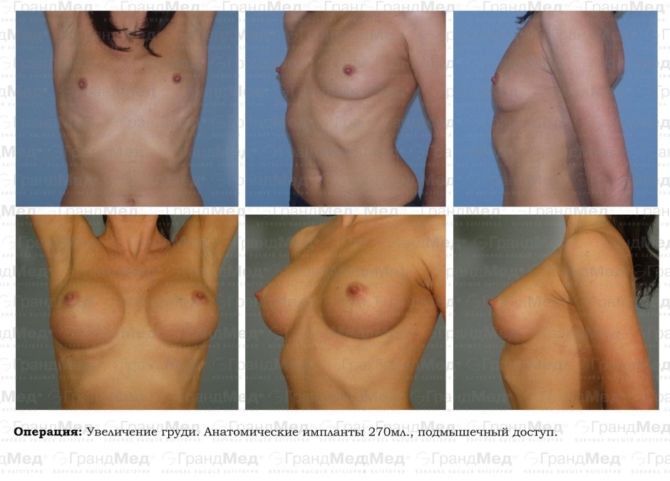 Грудь до и после операции