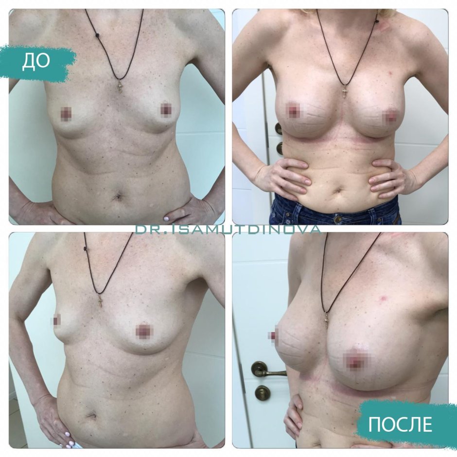 Анатомические импланты