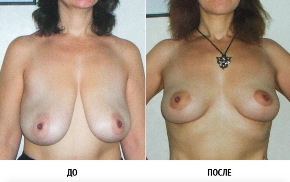 Пластика женских сосков