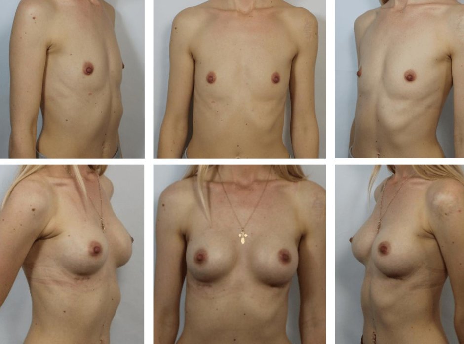 Конусовидная грудь