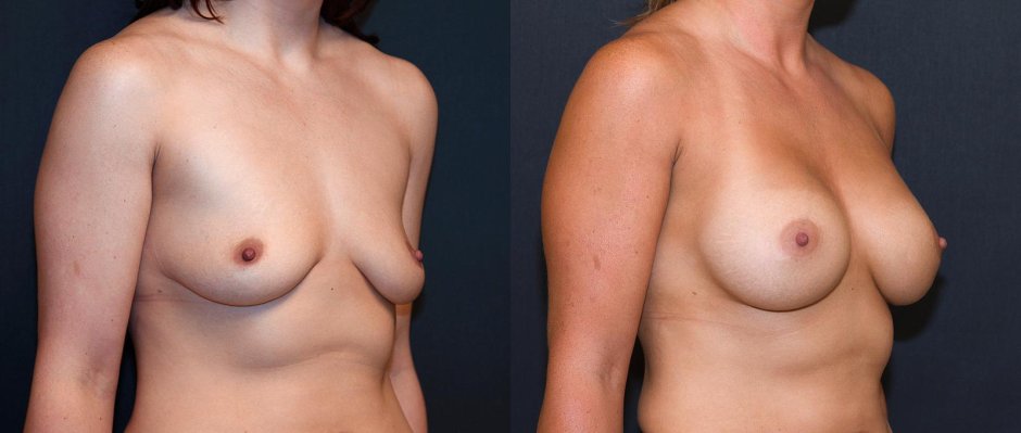 Тубулярная грудь