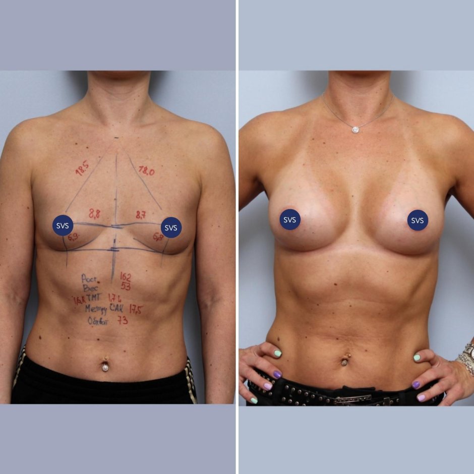 Увеличение груди имплантами