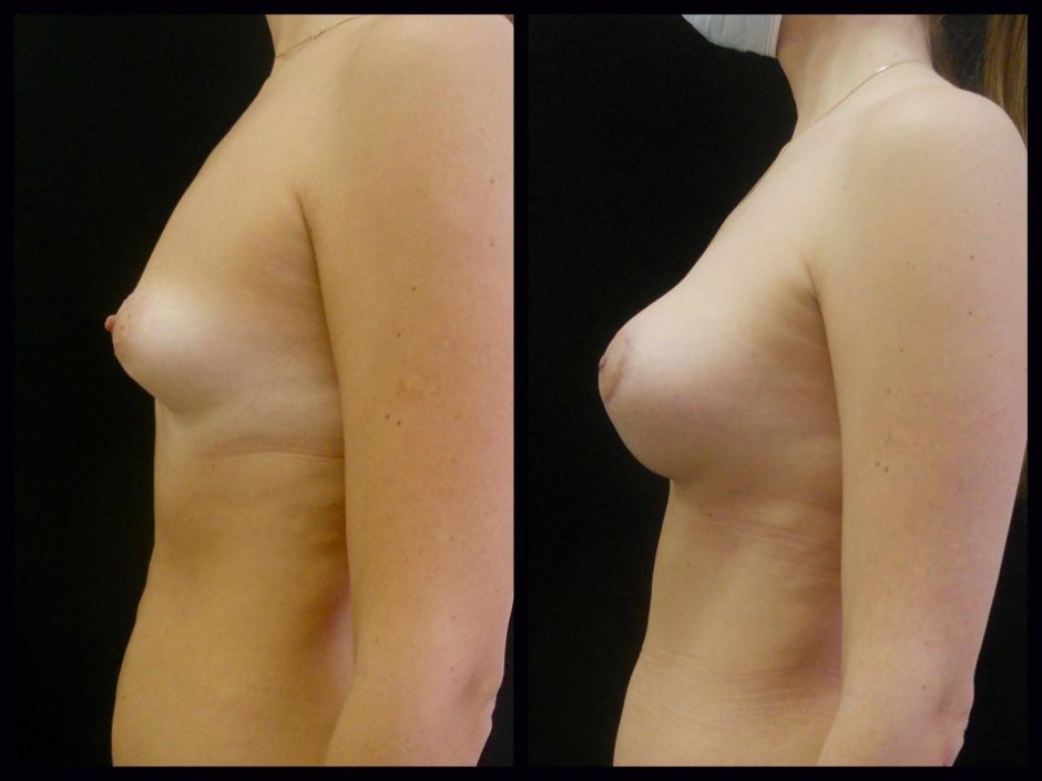 Тубулярная деформация груди