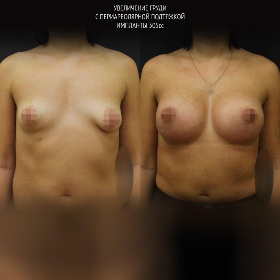 Импланты молочных желез
