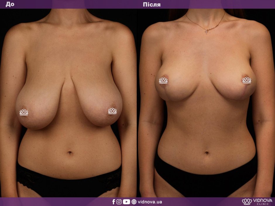 Грудь после увеличения