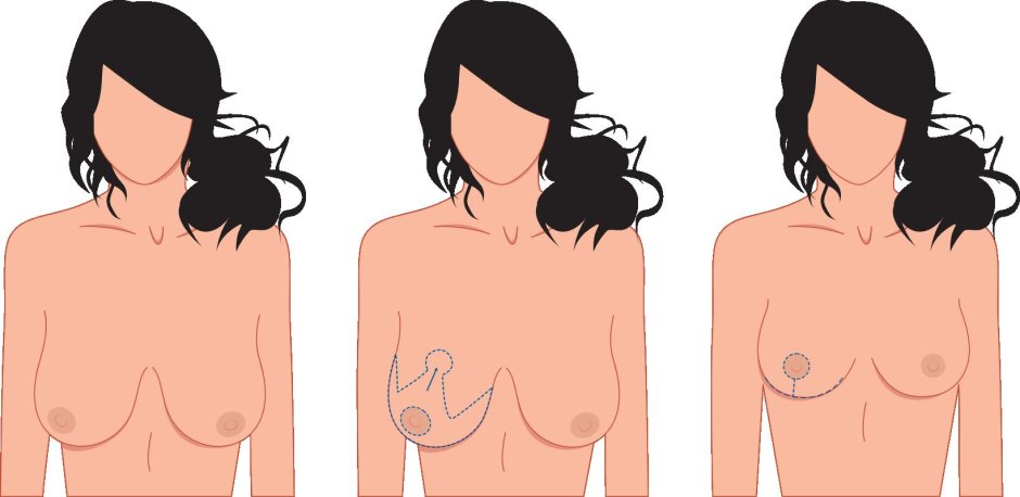 Форма женской груди