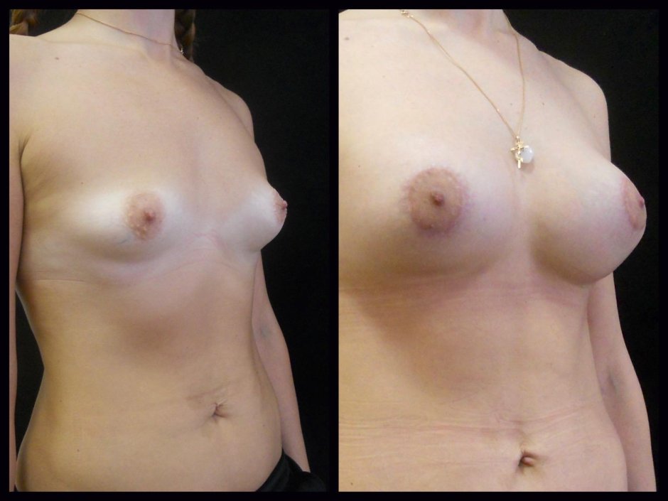 Тубулярная деформация груди у женщин